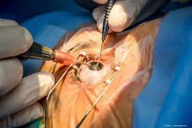 Ophthalmology Photo